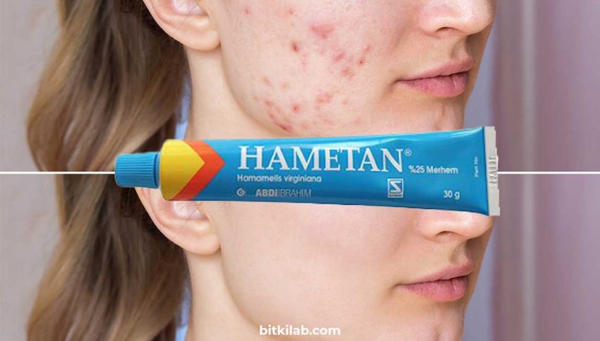 What Does Hametan Blue Cream Do? Why is Hametan Cream Used?