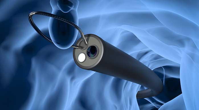 What is Colonoscopy? What Happens After Colonoscopy? Comments of those who had it done